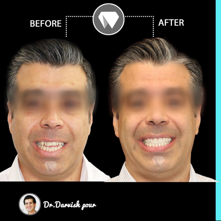 https://www.drdarvishpour.com/wp-content/uploads/2016/06/1889orthodontics-before-after-photo.jpg