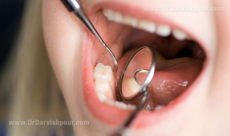 مقاوم سازی دندان
