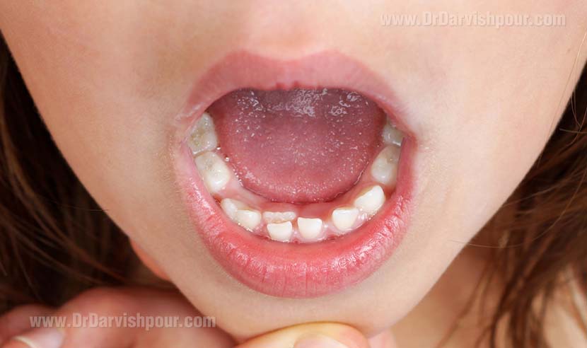 دندان های دائمی با چه روندی رشد می کنند؟