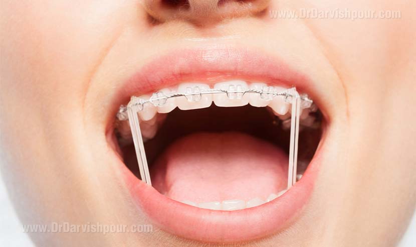 کش های ارتودنسی برای هدایت دندان در یک جهت خاص کش های ارتودنسی برای هدایت دندان در یک جهت خاص