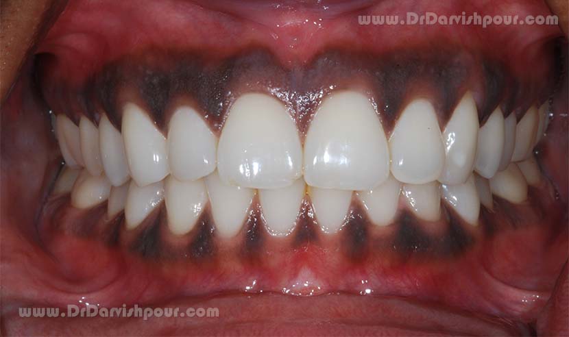تغییر رنگ لثه به چه علت است؟ تغییر رنگ لثه به چه علت است؟