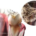 عفونت دندان چیست و چگونه به وجود می آید؟ عفونت دندان چیست و چگونه به وجود می آید؟