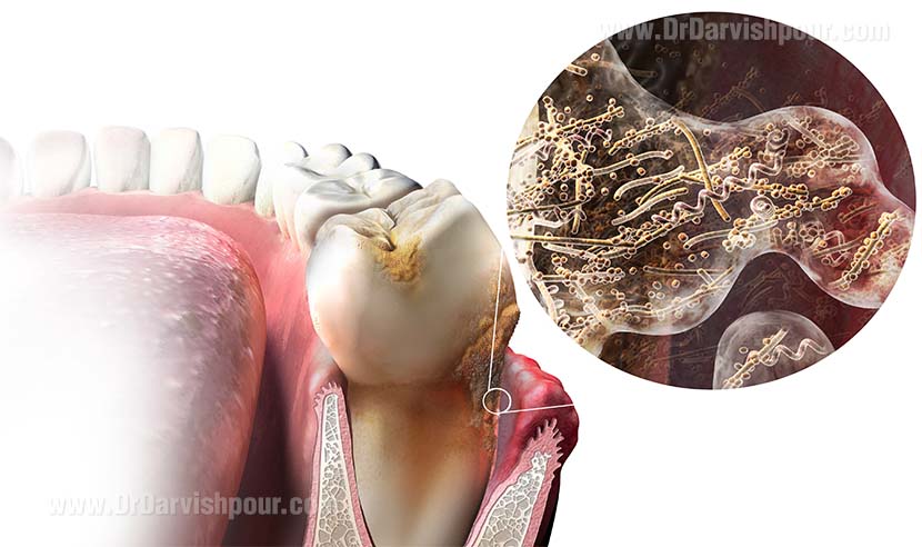عفونت دندان چیست و چگونه به وجود می آید؟
