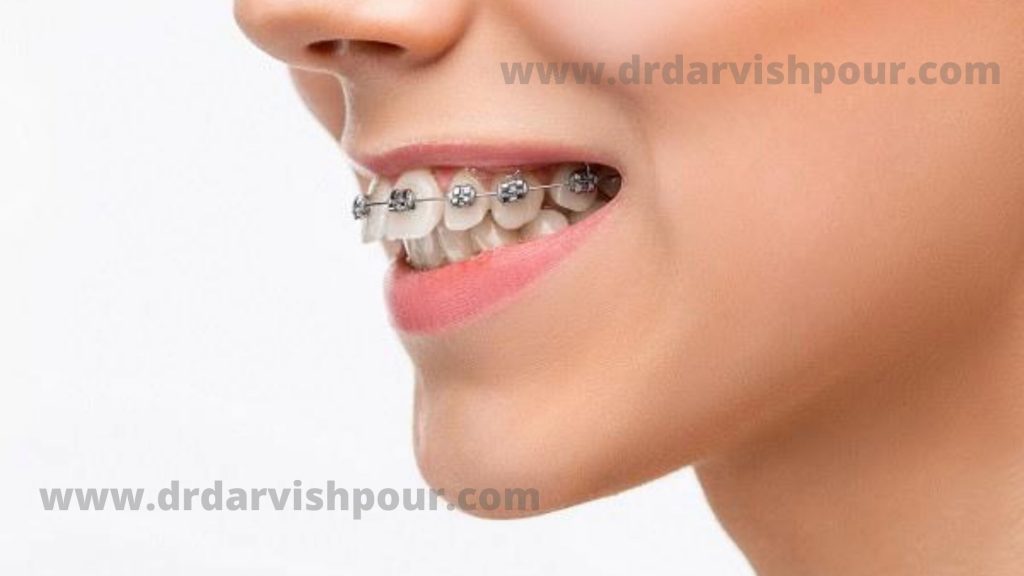 ارتودنسی فک پایین و بالا با هم