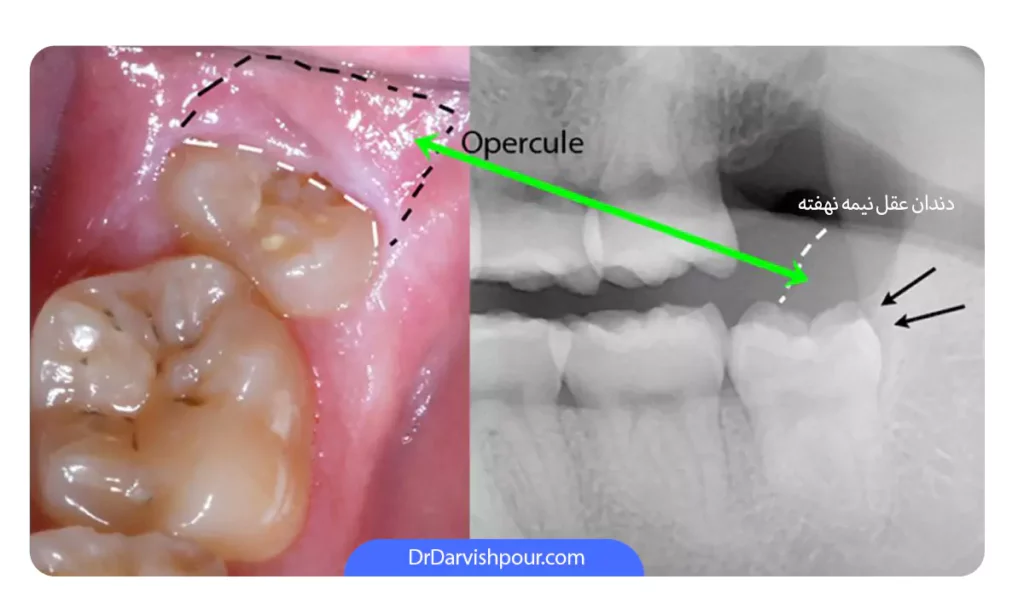 عکس دندان عقل نیمه نهفته