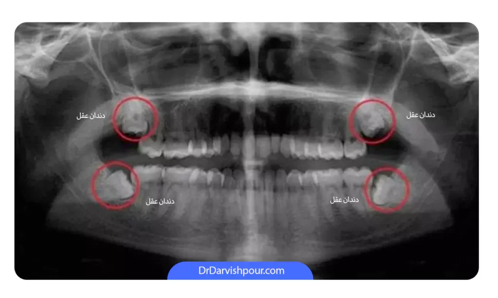 عکس 4 دندان عقل واقعی