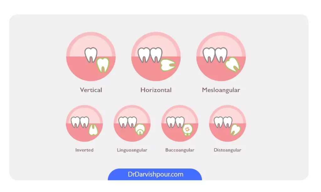 عکس وضعیت های مختلف نهفتگی دندان