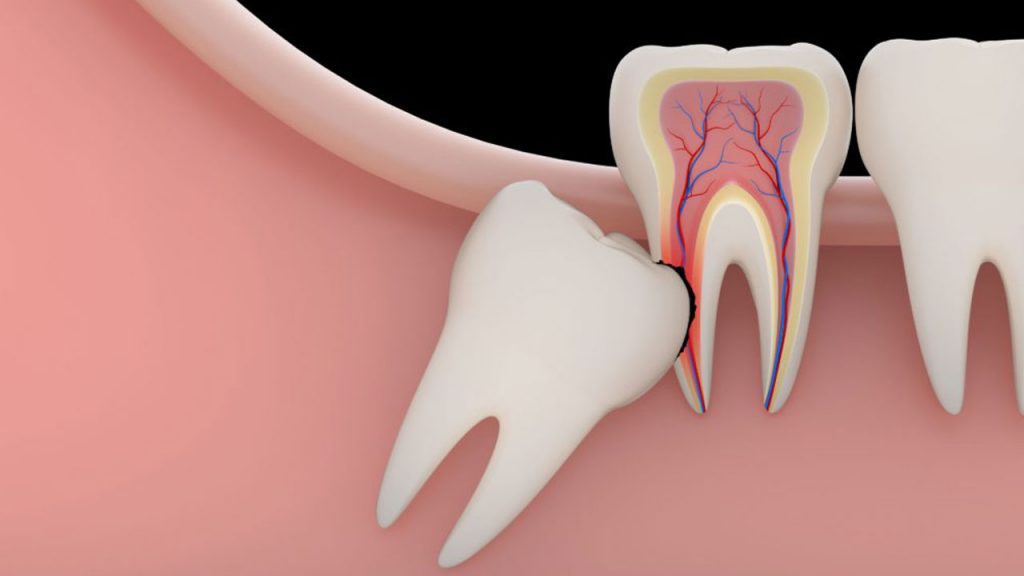 تصویر یک دندان عقل نهفته که به صورت مایل در آمده و باعث وارد شدن آسیب به دندان مجاور خودش شده. 