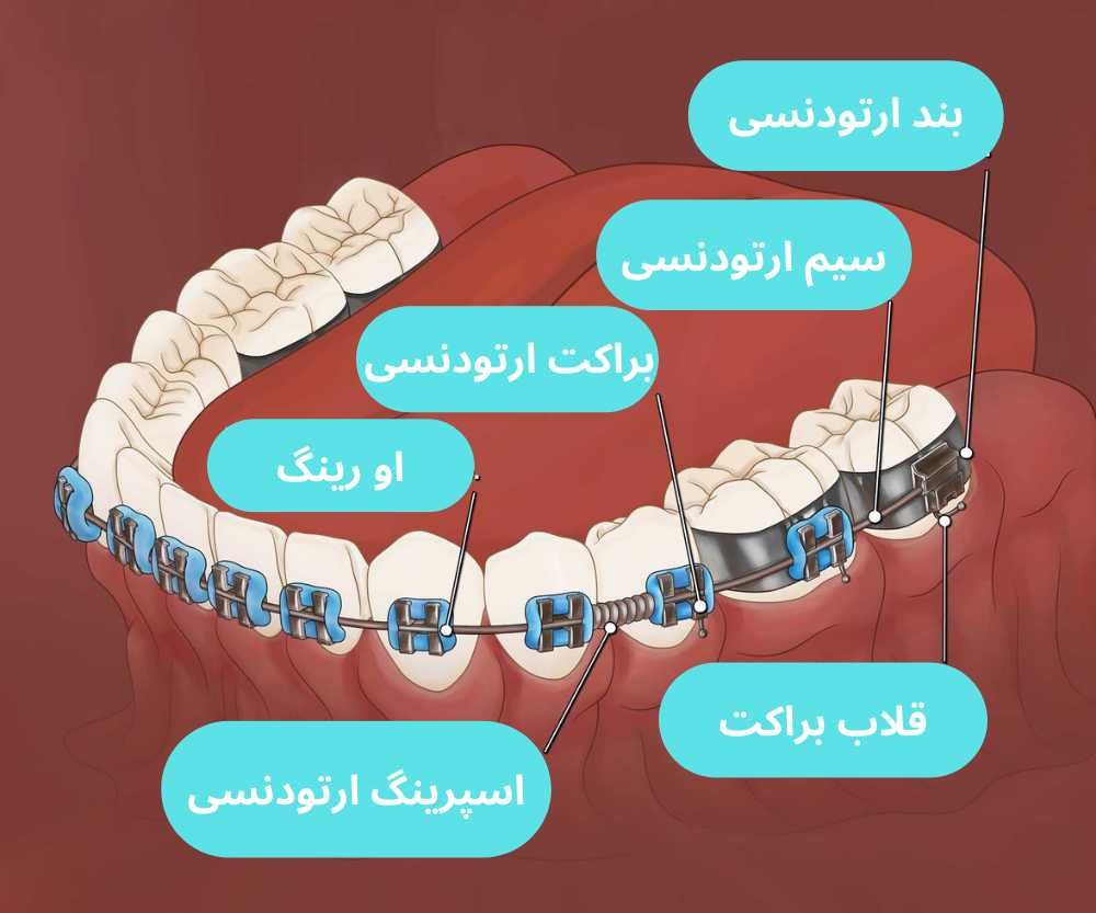 اجزای ارتودنسی ثابت