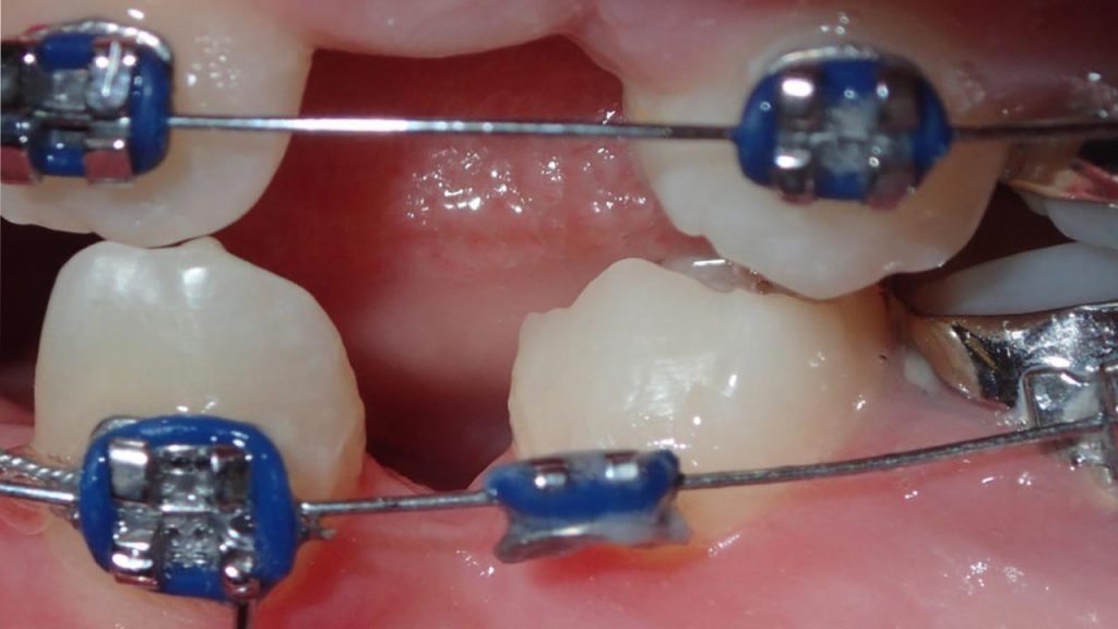 وجود فاصله بین دندان ها که در نتیجه کشیدن دندان در طول ارتودنسی بوده