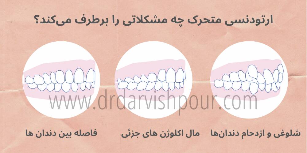 اینفوگرافی مشکلات و ناهنجاری هایی که با ارتودنسی متحرک برطرف می شوند.
