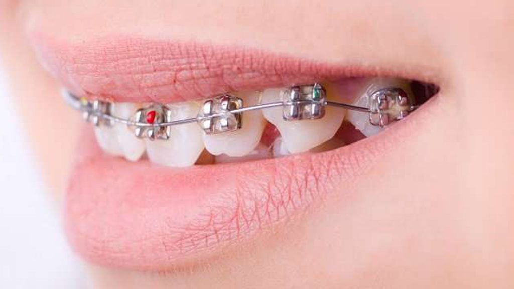 تصویر دختری که روی دندان هایش بریس ارتودنسی است