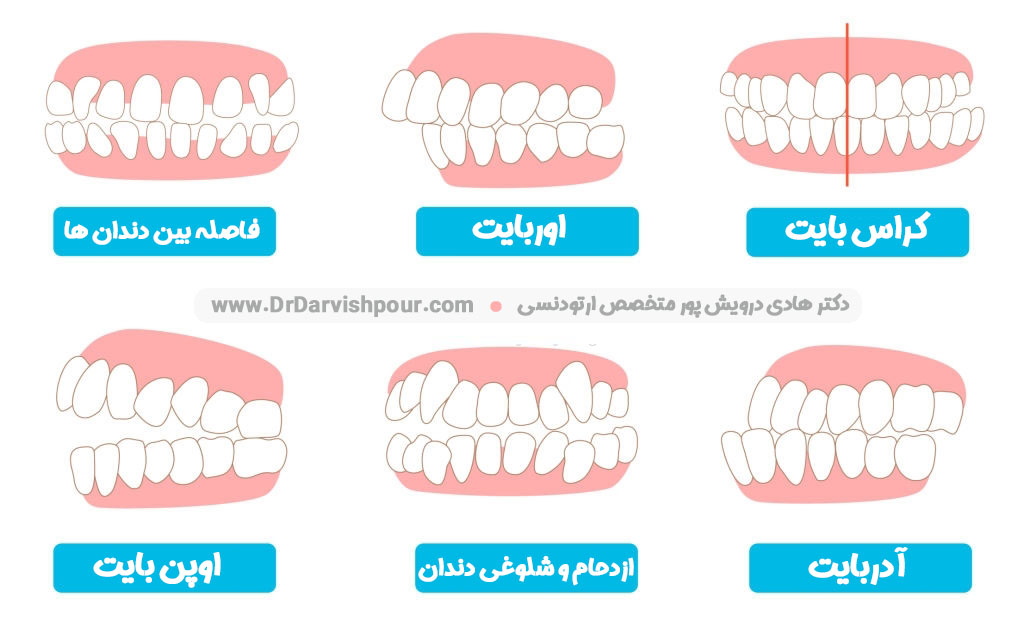 انواع مشکلات و ناهنجاری فکی و دندانی که با کمک ارتودنسی ثابت درمان می شوند.