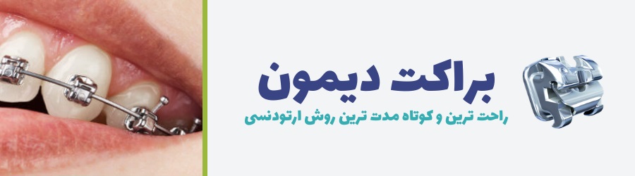 تصویر براکت و سیستم ارتودنسی دیمون