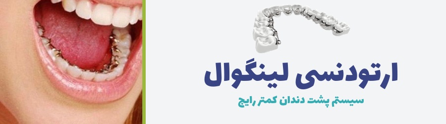 تصویر سیستم ارتودنسی لینگوال و هزینه ارتودنسی با این روش