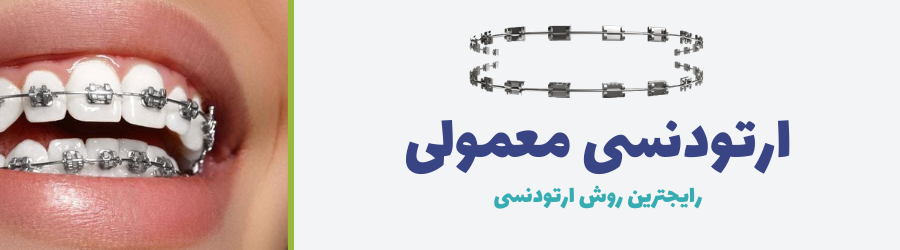 تصویر سیستم ارتودنسی ثابت معمولی به عنوان رایجترین سیستم ارتودنسی دندان