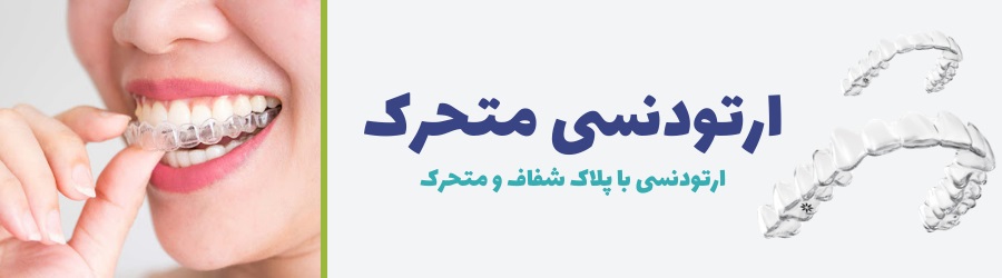 تصویر پلاک متحرک و شفاف ارتودنسی و هزینه ارتودنسی با این روش