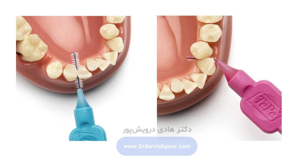 کاربرد مسواک بین دندانی یا ارتودنسی