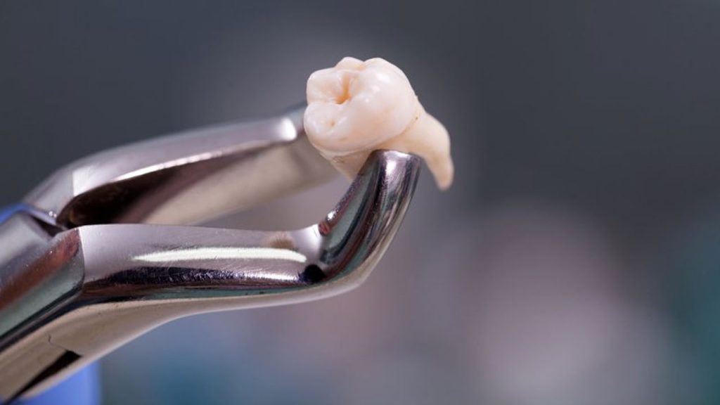 کشیدن دندان، تصویر یک دندان کشیده شده با فورسپس