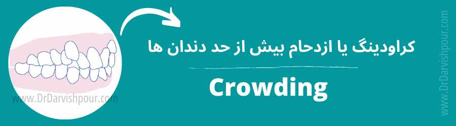 ازدحام و شلوغی دندان ها