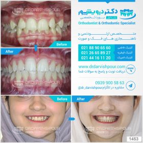 1453orthodontics-before-after-photo