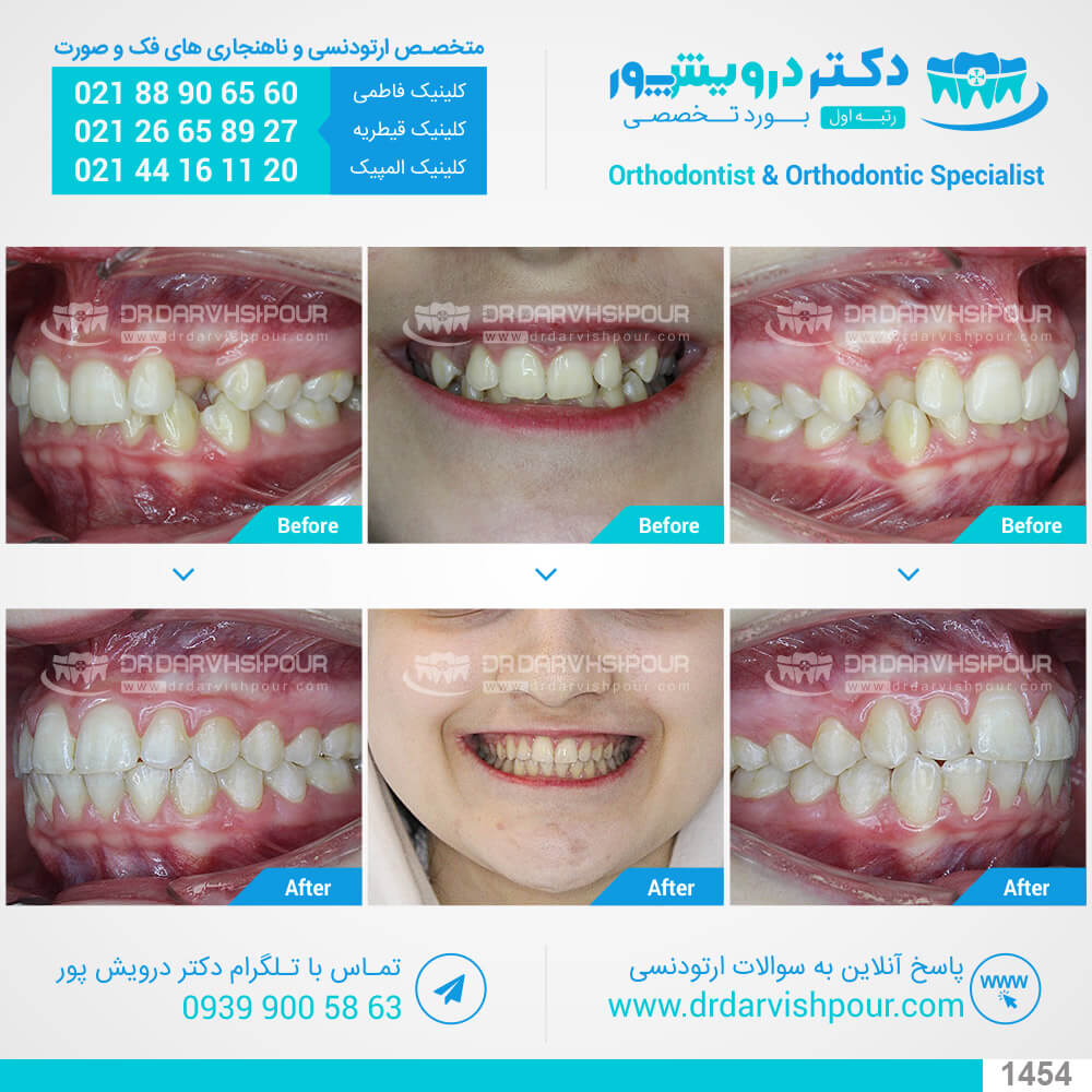 1454orthodontics-before-after-photo