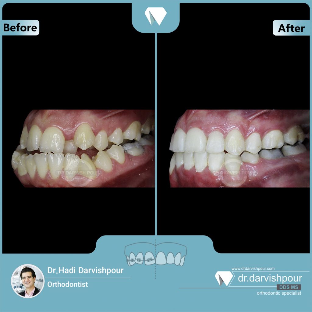تصویر شماره 3 ارتودنسی دندان قبل و بعد