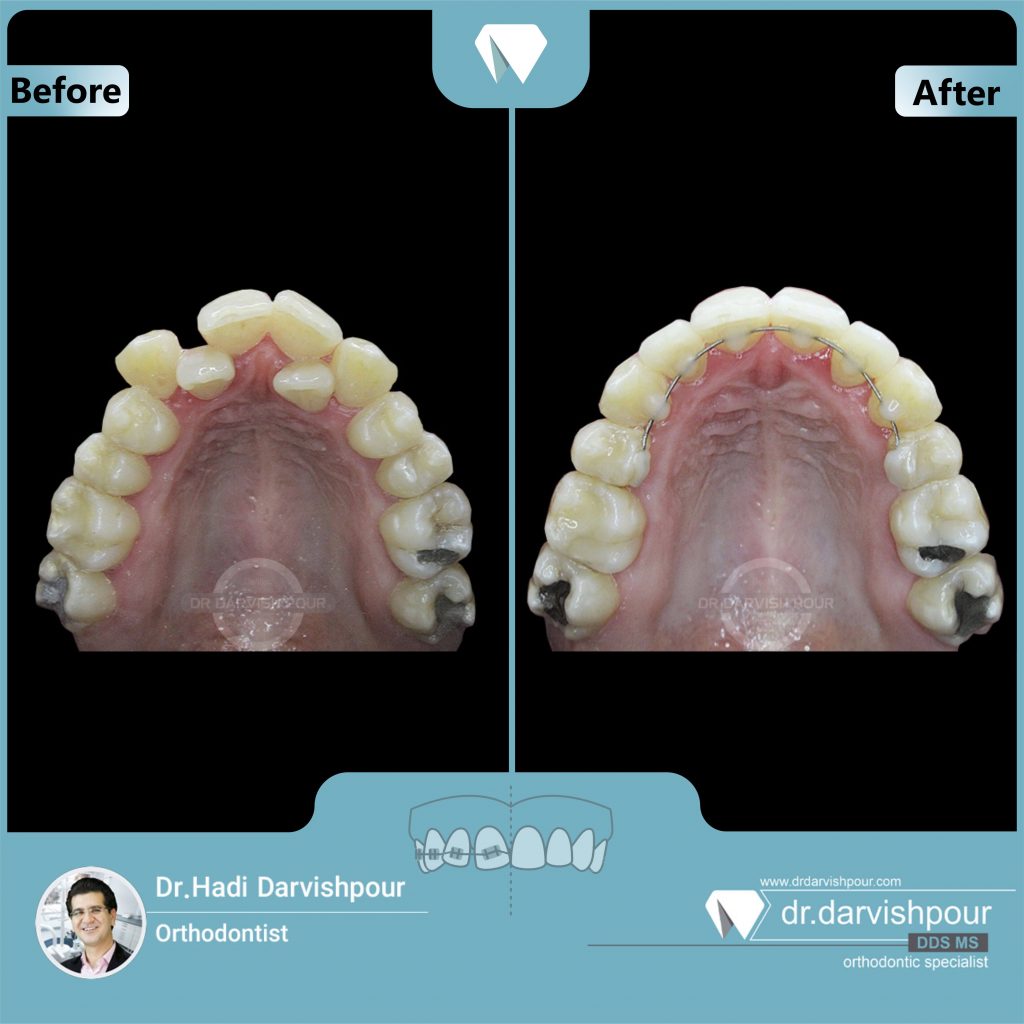 تصویر شماره 2 ارتودنسی دندان قبل و بعد