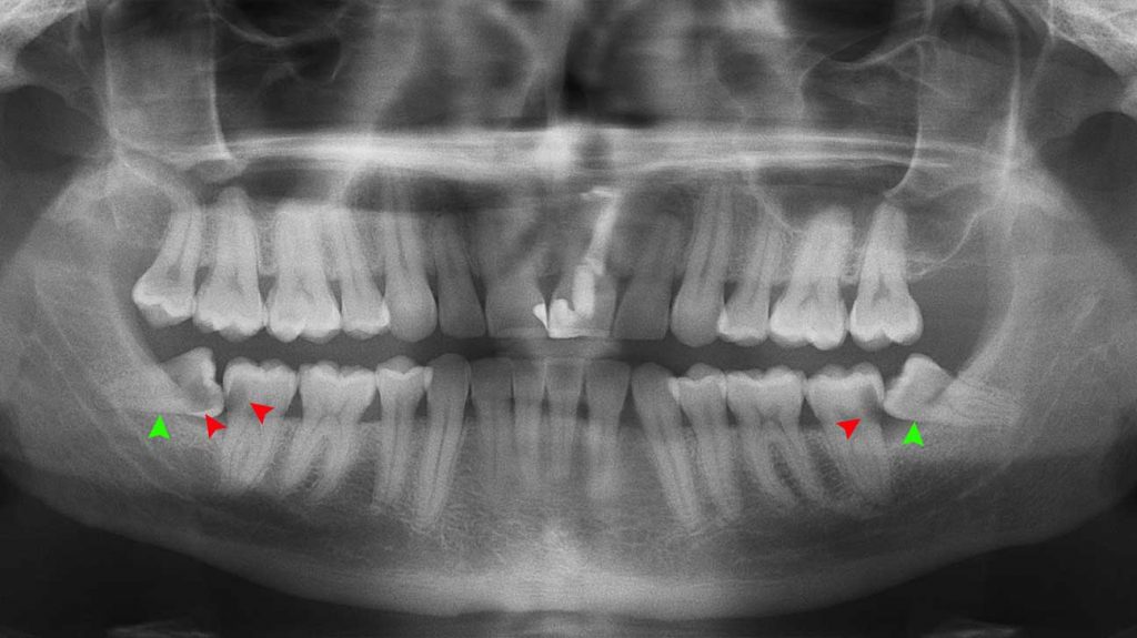 کشیدن دندان عق نهفته برای ارتودنی و تصاور رادیولوژی آن