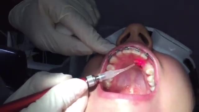 جراحی دندان نیش نهفته با لیزر در ارتودنسی