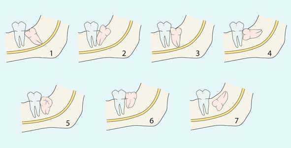 اشکل مختلف دندان نهفته و لزوم کشیدن دندان عقل برای ارتودنسی