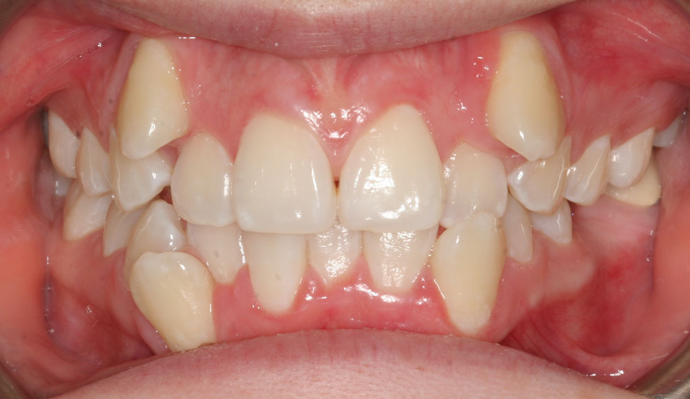 لق شدن ارتودنسی ناشی از ازدحام بیش از حد دندان ها
