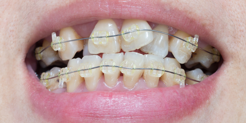 ارتودنسی دندانهای کج با کمک بریس