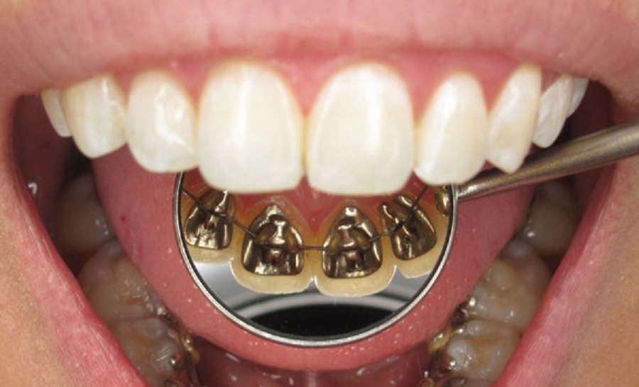 عکسی که ارتودنسی لینگوال را با آینه دندانپزشکی نشان می دهد