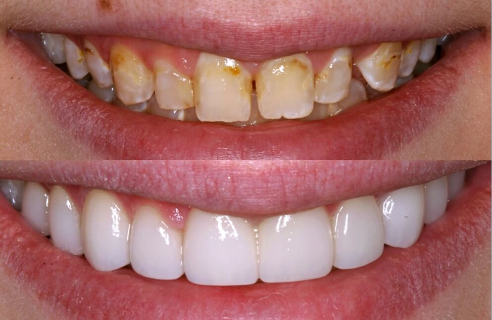 تغییر رنگ دندان ها و برطرف کردن آن با لمینت دندان