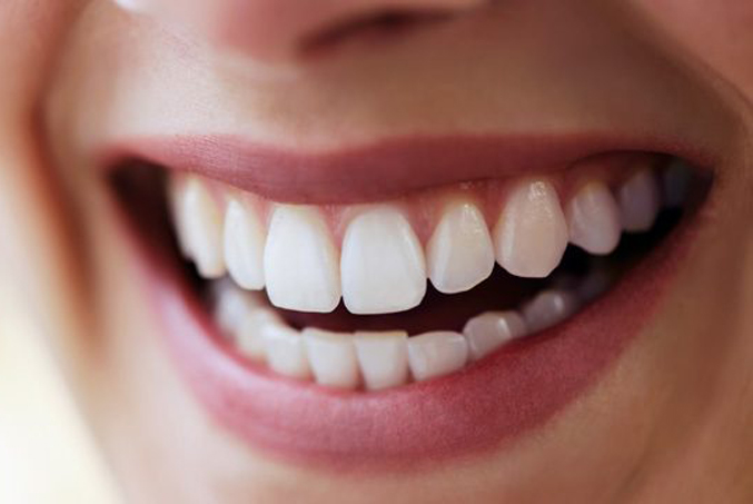 تصویر دندان هایی که با کمک لمینت دندان زیباتر شده اند