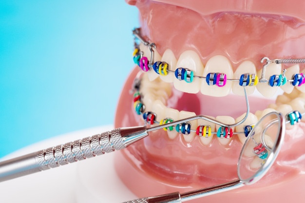 انواع بریس ارتودنسی دندان