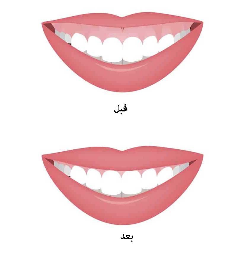 جراحی لب برای برطرف کردن لبخند لثه ای