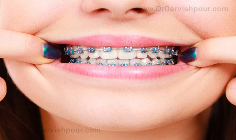 dental braces