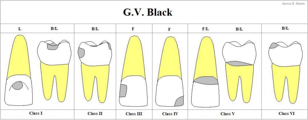 تصویری که طبقه بندی پوسیدگی دندان را نشان می دهد.