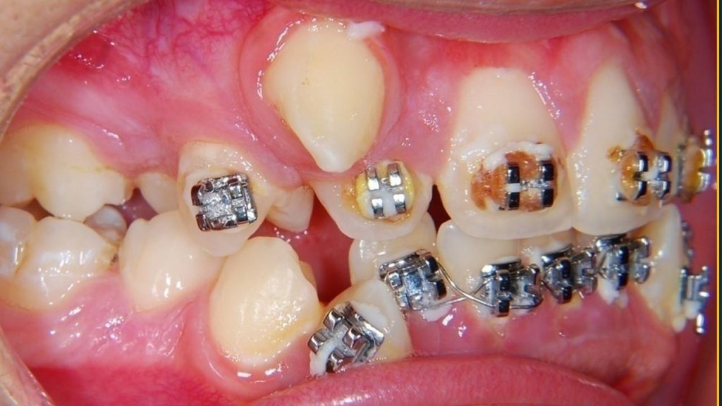 درمان دندان نیش نهفته با ارتودنسی