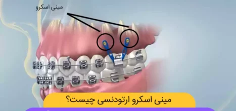 عکس مینی اسکرو