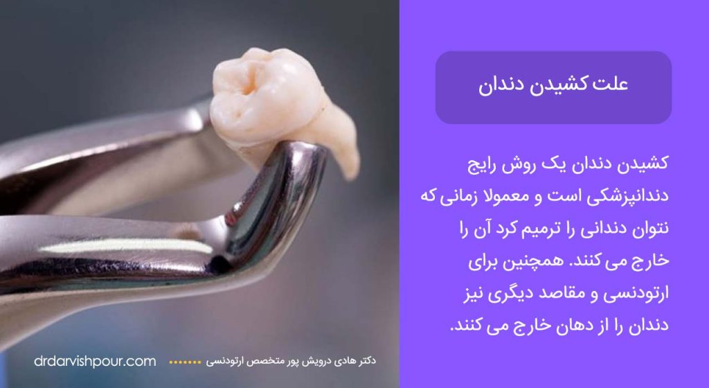 اینوگرافی توضیح علت کشیدن دندان