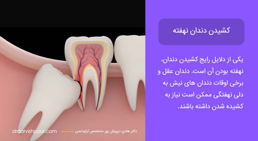 اینفوگرافی کشیدن دندان نهفته
