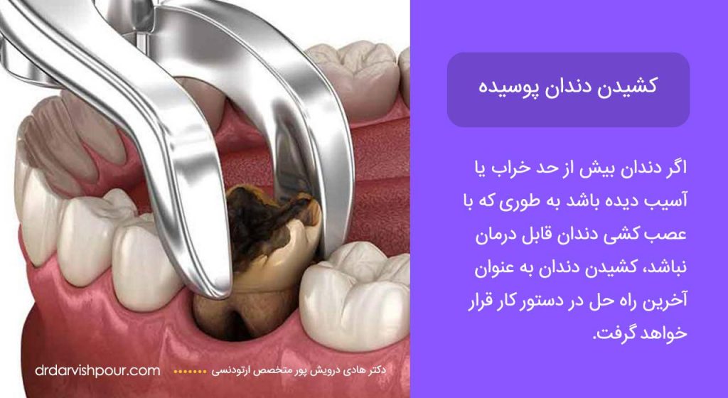 اینفوگرافی کشیدن دندان پوسیده