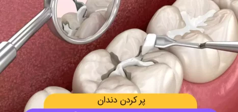 پر کردن دندان عکس