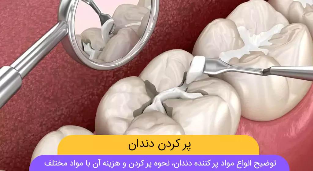 پر کردن دندان عکس