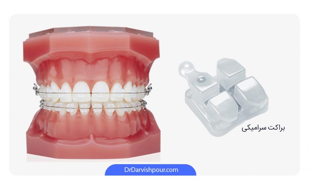 عکس ارتودنسی سرامیکی یک مولاژ به همراه براکت سرامیکی