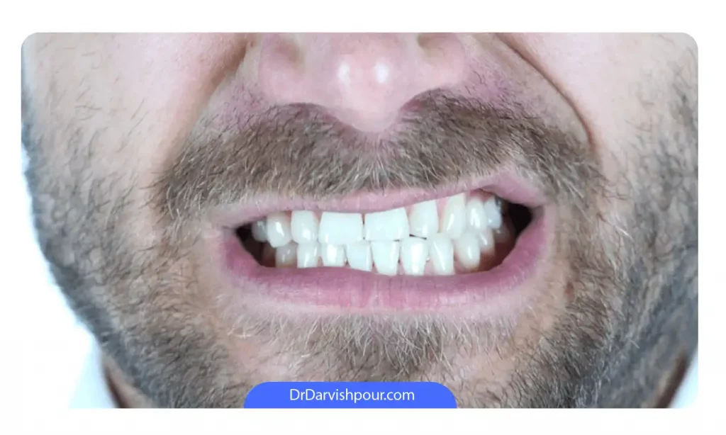 یک مرد که در حال دندان قروچه است