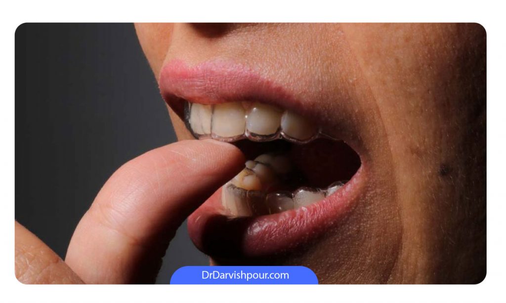 این عکس نشان می دهد که چطور یک مراجع خانم الاینر ارتودنسی نامرئی خود را روی دندان ها قرار می دهد